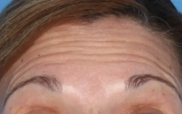 Aplicação de Botox - antes - resultado real Clínica Dra. Simoni Bett Joinville