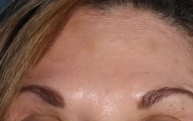 Aplicação de Botox - depois - resultado real Clínica Dra. Simoni Bett Joinville