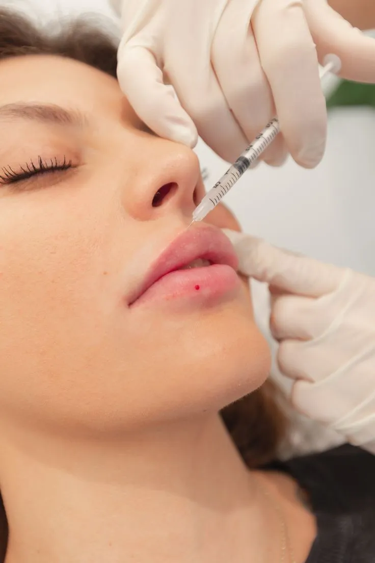 Aplicação injetável próxima à região dos lábios em atendimento de harmonização facial na Clínica Dra. Simoni Bett, Joinville