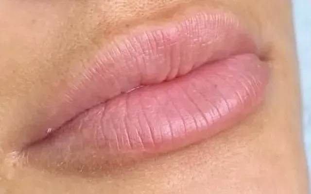 Harmonização Facial - antes - resultado real Clínica Dra. Simoni Bett Joinville