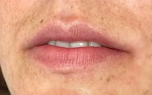 Harmonização Facial - antes - resultado real Clínica Dra. Simoni Bett Joinville