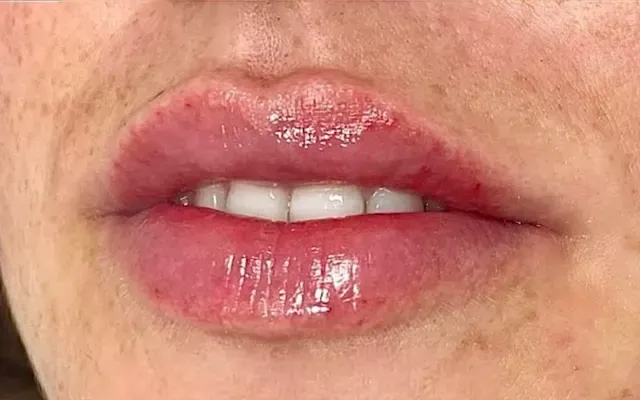 Harmonização Facial - depois - resultado real Clínica Dra. Simoni Bett Joinville