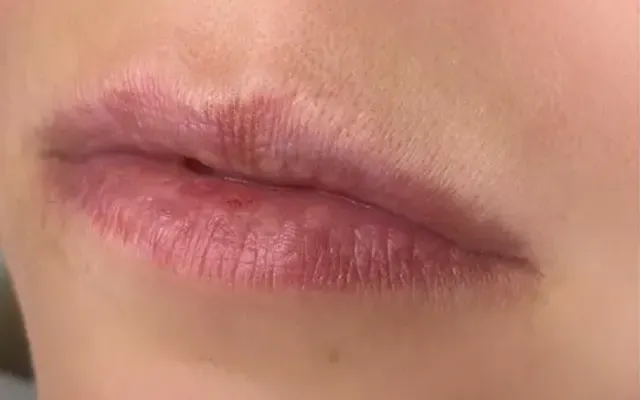 Harmonização Facial - antes - resultado real Clínica Dra. Simoni Bett Joinville