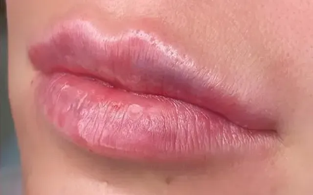Harmonização Facial - depois - resultado real Clínica Dra. Simoni Bett Joinville