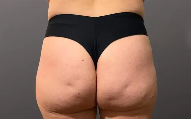 Harmonização de Glúteos - antes - resultado real Clínica Dra. Simoni Bett Joinville