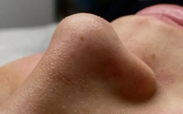 Limpeza de Pele - antes - resultado real Clínica Dra. Simoni Bett Joinville