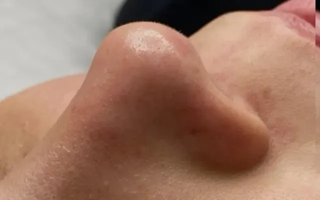 Limpeza de Pele - depois - resultado real Clínica Dra. Simoni Bett Joinville
