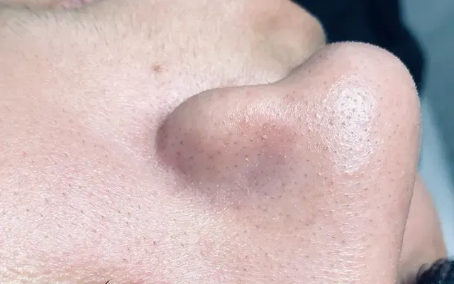 Limpeza de Pele - antes - resultado real Clínica Dra. Simoni Bett Joinville