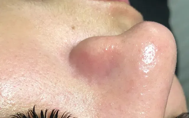 Limpeza de Pele - depois - resultado real Clínica Dra. Simoni Bett Joinville