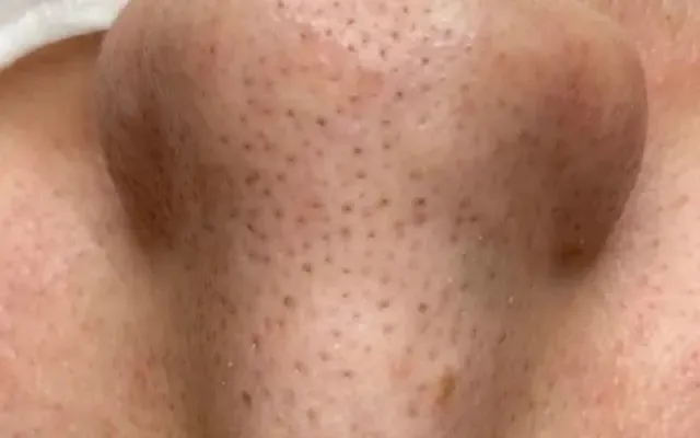 Limpeza de Pele - antes - resultado real Clínica Dra. Simoni Bett Joinville