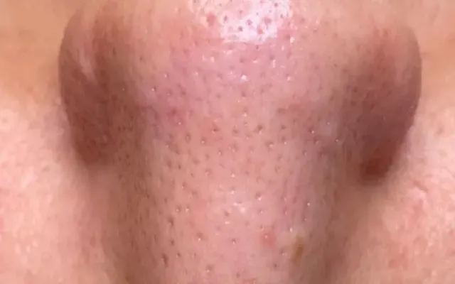 Limpeza de Pele - depois - resultado real Clínica Dra. Simoni Bett Joinville