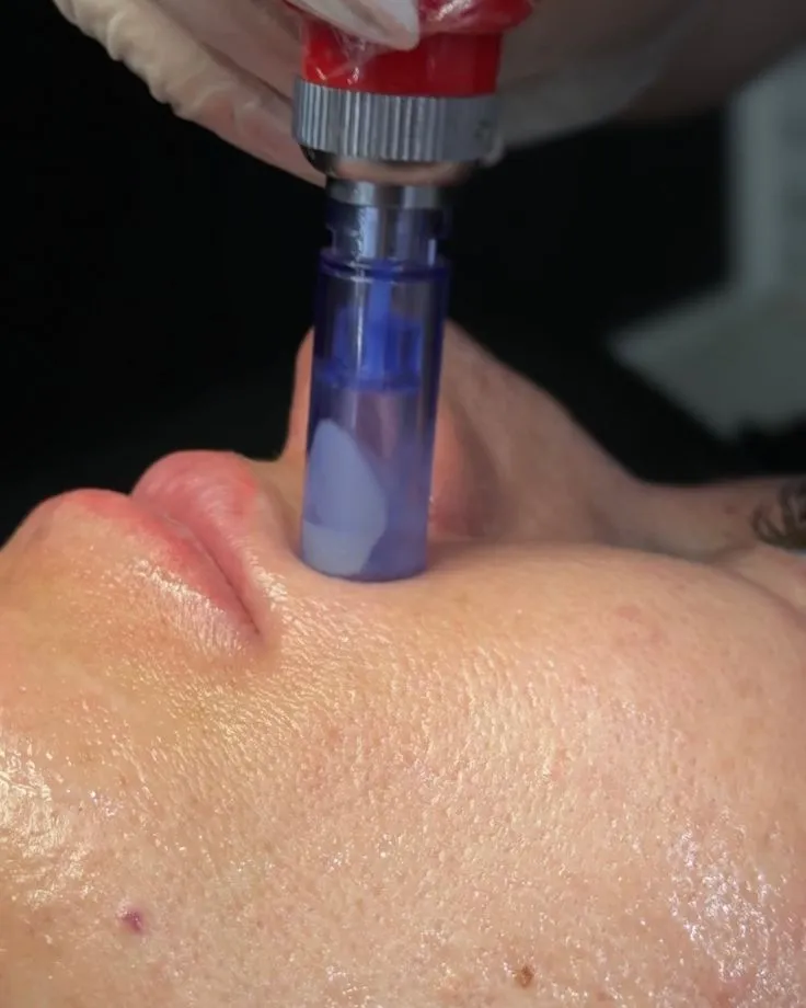 Close de ponteira de dermapen sobre a pele do rosto em microagulhamento na Clínica Dra. Simoni Bett, Joinville