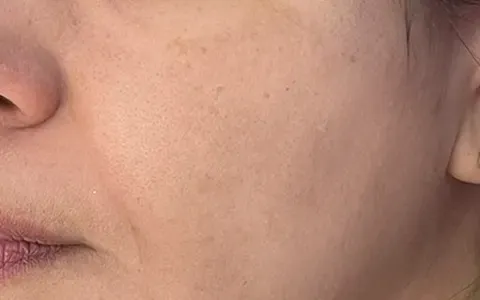 Peeling - depois - resultado real Clínica Dra. Simoni Bett Joinville