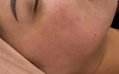 Peeling - depois - resultado real Clínica Dra. Simoni Bett Joinville