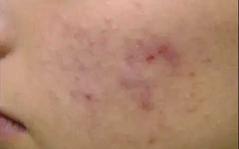 Peeling - antes - resultado real Clínica Dra. Simoni Bett Joinville