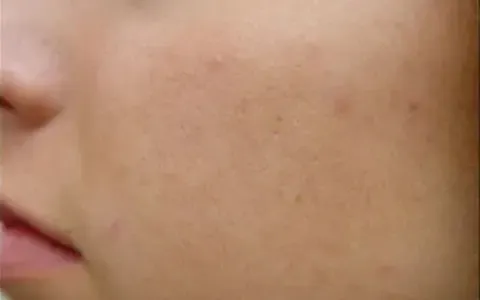 Peeling - depois - resultado real Clínica Dra. Simoni Bett Joinville