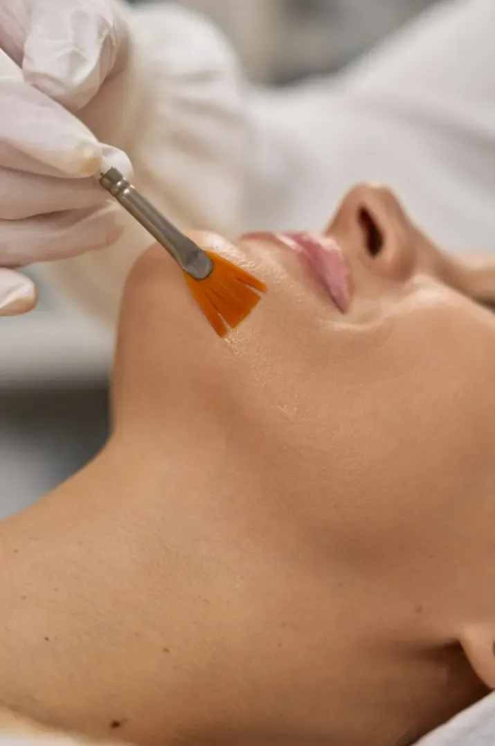 Aplicação de peeling com pincel no queixo e no pescoço da paciente na Clínica Dra. Simoni Bett, Joinville