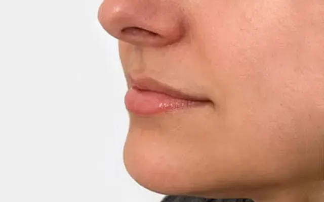 Preenchimento Labial - antes - resultado real Clínica Dra. Simoni Bett Joinville
