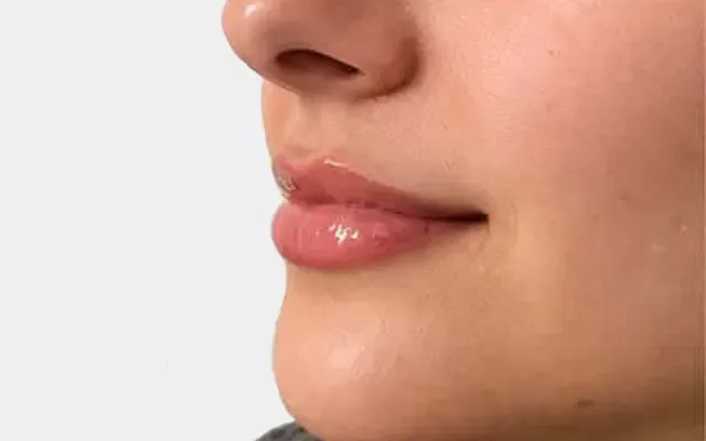 Preenchimento Labial - depois - resultado real Clínica Dra. Simoni Bett Joinville