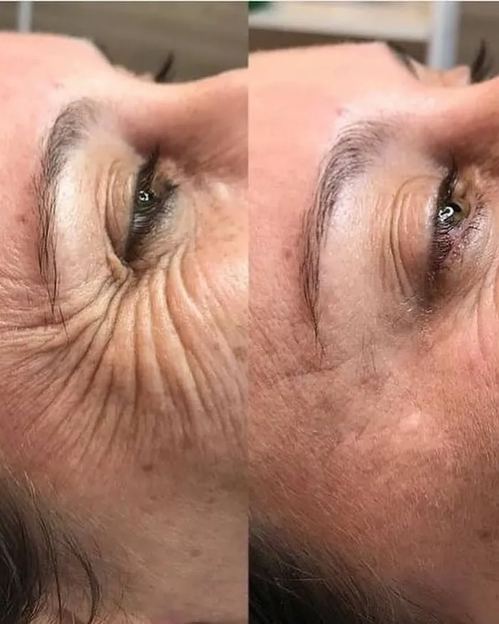 Resultado de tratamento de firmeza facial na Clínica Dra. Simoni Bett, Joinville