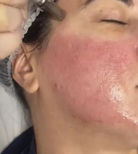 Pele com Acne em Tratamento em Joinville Pele com vermelhidão e lesões de acne durante atendimento de tratamento de acne na Clínica Dra. Simoni Bett, Joinville
