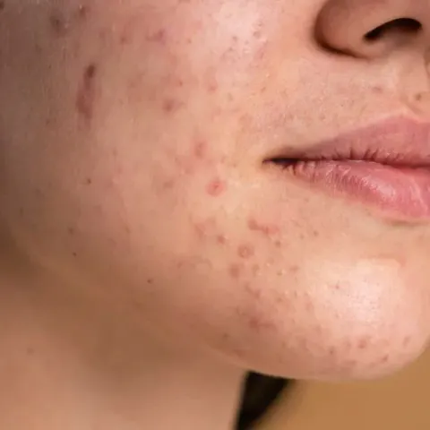 Tratamento de Acne em Joinville - Clínica Dra. Simoni Bett