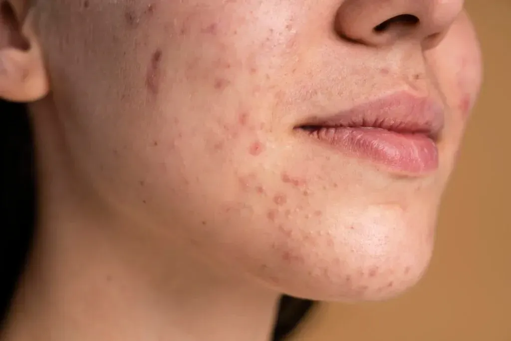 Tratamento de Acne em Joinville - Clínica Dra. Simoni Bett