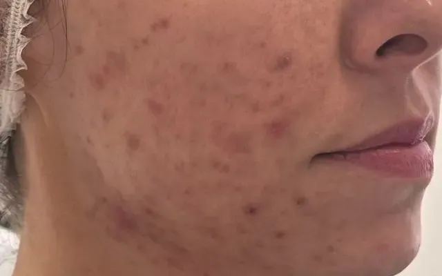 Tratamento de Acne - antes - resultado real Clínica Dra. Simoni Bett Joinville