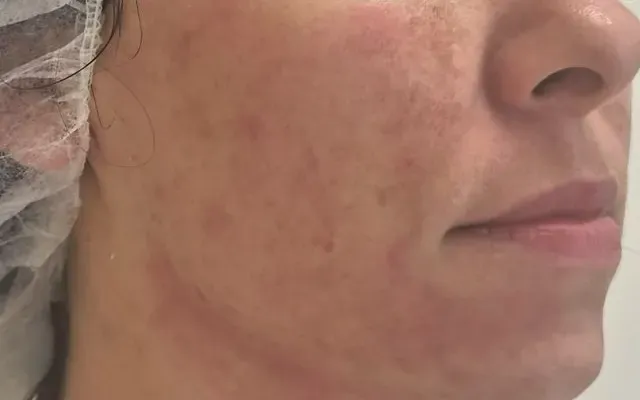 Tratamento de Acne - depois - resultado real Clínica Dra. Simoni Bett Joinville