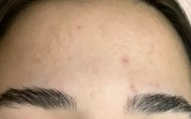 Tratamento de Acne - antes - resultado real Clínica Dra. Simoni Bett Joinville