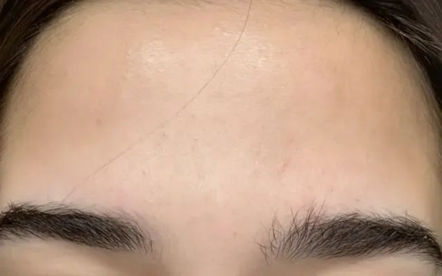 Tratamento de Acne - depois - resultado real Clínica Dra. Simoni Bett Joinville