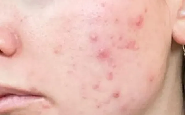 Tratamento de Acne - antes - resultado real Clínica Dra. Simoni Bett Joinville