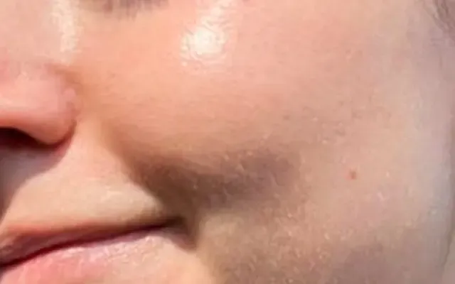 Tratamento de Acne - depois - resultado real Clínica Dra. Simoni Bett Joinville